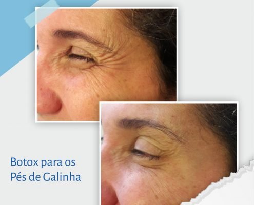 Botox Pés de Galinha