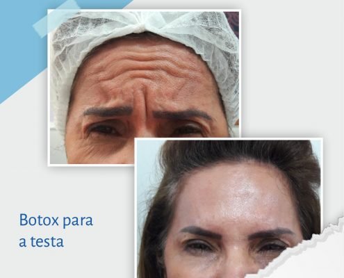 Botox testa