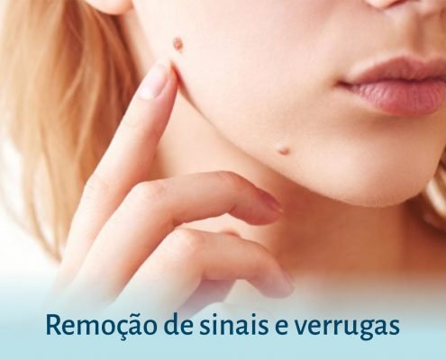 Remoção de sinais e verrugas